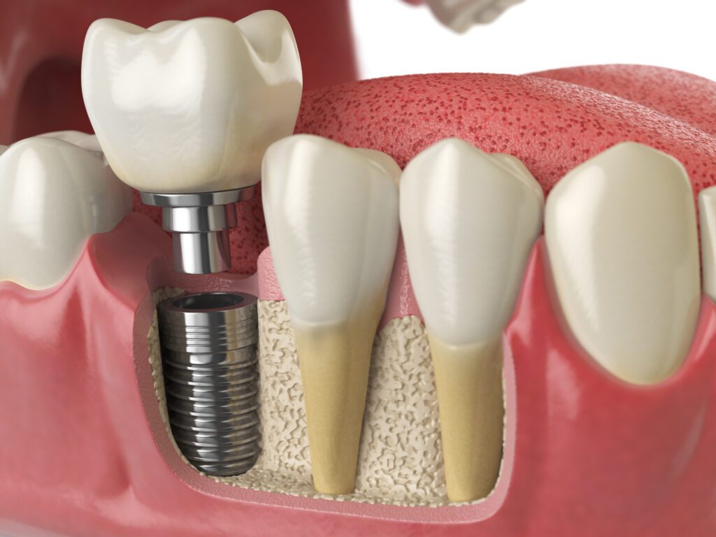 Dental Implants in Canton, TX