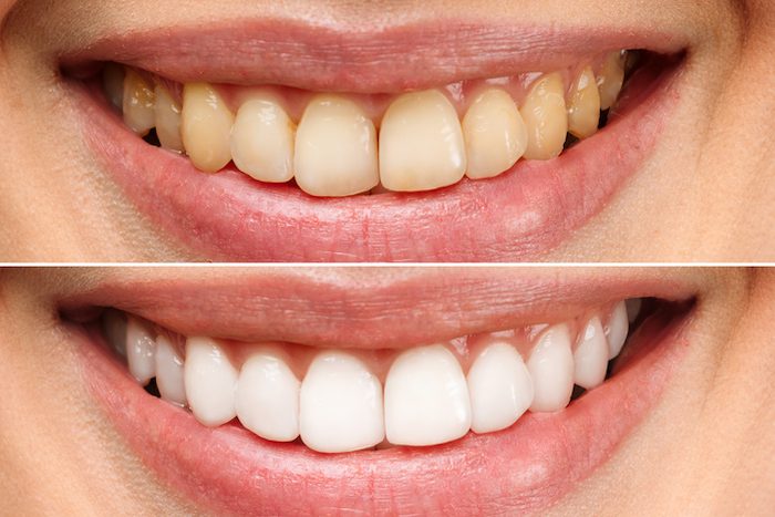 teeth whitening treatment in canton, texas