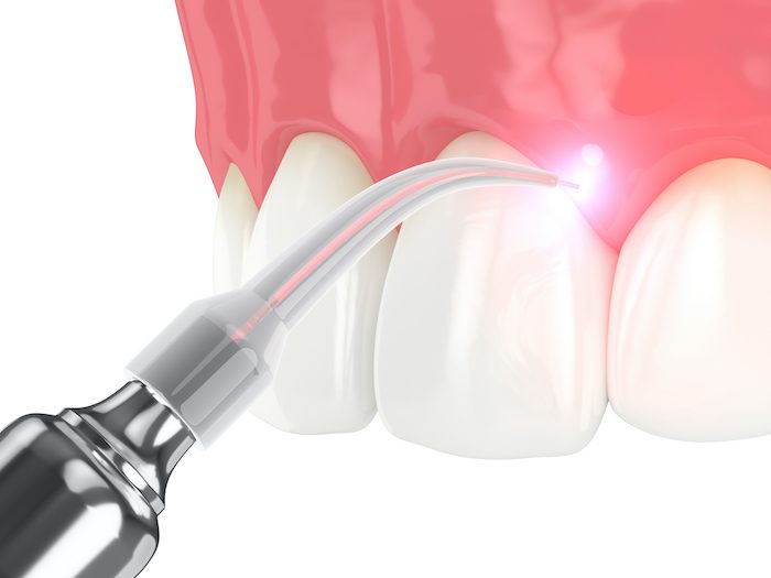 laser dental treatment in canton, texas